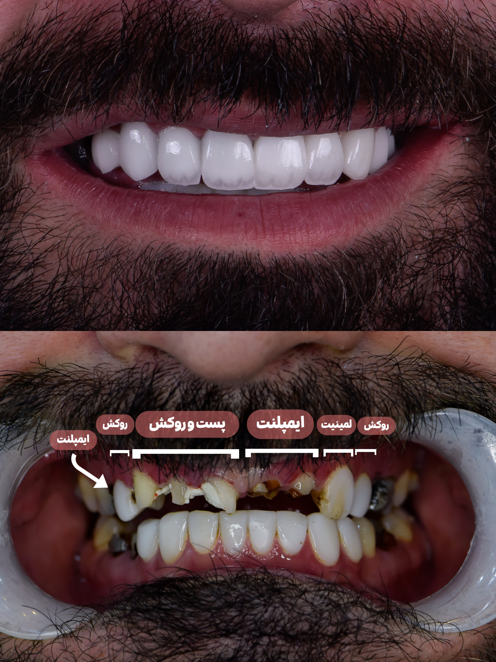 ترکیبی لمینیت و زیرکونیا